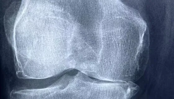 Blogujmy24.pl: Znaczenie diety w procesie gojenia po rekonstrukcji łąkotki., Artykuły | Dieta