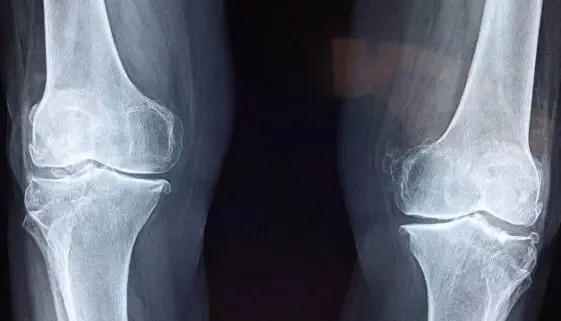 Blogujmy24.pl: Optymalizacja rehabilitacji po rekonstrukcji łąkotki kolana., Artykuły | Łąkotka kolana